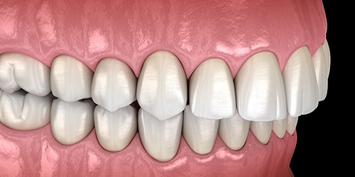 Illustration of an overbite