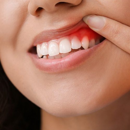 a woman lifting her lips to show red gums