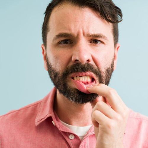 a man showing signs of gum disease