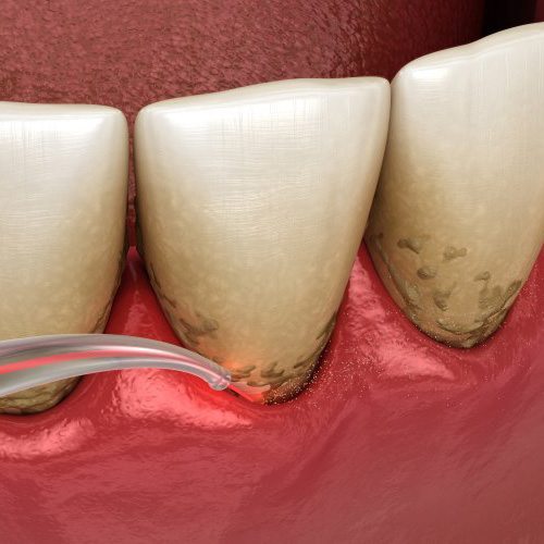 a 3D depiction of laser periodontal treatment