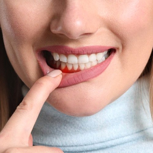 a woman showing signs of gum disease