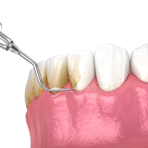 a 3D illustration of scaling and root planing process