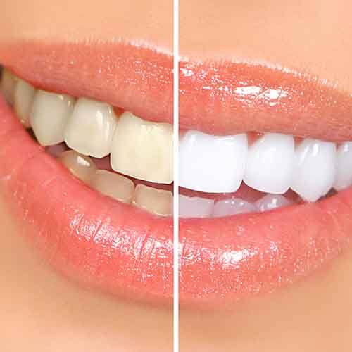 Closeup of a smile that’s halved into before/after whitening