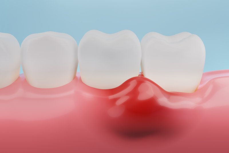 Illustration of gum disease