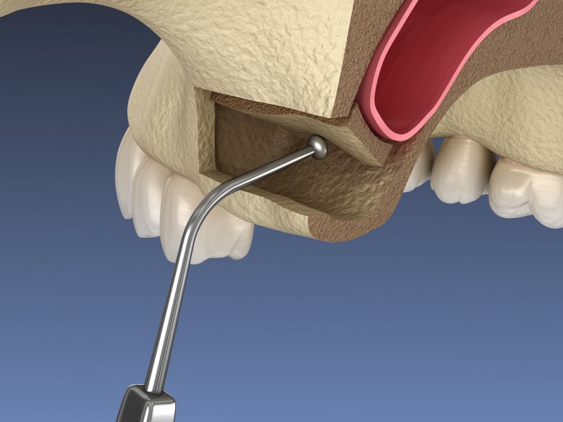 digital image of a sinus lift 